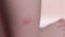 Small child with a mosquito bite on his leg