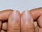 Small or missing lunulae or half-moons at fingernails with longitudinal lines