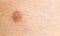 Small mole nevus on human skin, carcinoma. Background, macro