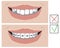 A smile with crooked teeth and with metal braces before and after the dental clinic, a vector stock illustration with molars as a