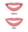 The smile with large and dark buccal corridor before and after correction. Vector illustration. Dark spaces at the edge