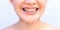 Smiling Asian woman wearing orthodontic retainer. Dental care and healthy