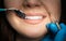 Smiling beautiful happy brunette woman patient examined by dentist in blue gloves using dental mirror and scaler during dental