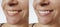 Smiling beautiful woman dentistry concept  before after bleaching teeth whitening procedure