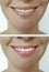 Smiling beautiful woman dentistry concept laugh before after bleaching teeth whitening procedure