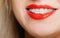 Smiling girl with braces face part teeth straighten, tooth hygiene