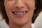 Smiling young male patients face with dental braces