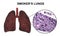Smoker`s lungs, medical concept