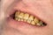 Smoking, plaque on teeth Brown resinous plaque on teeth close-up. Smoking harm concept