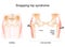 Snapping hip syndrome. Coxa saltans