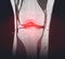 A snapshot of the diagnosis of an MRI of the knee in which arthrosis and arthritis. The concept of joint diagnosis using x-rays,