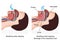 Snoring medical  illustration with description on white background