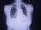 Soft and blurry x-ray chest reticular infiltration at right lobe.Moderate cadiomegaly.Both costophrenic angles are clear.Intract o