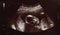 Sonogram of fetus