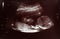 Sonogram of a human foetus