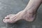 Southeast Asian, Myanmar old womanâ€™s foot of lateral view. Skin creases, loosen skin and veins show aging