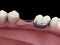 Space Maintainer Unilateral keeps from teeth shift deformatiuon after losing molar tooth. 3D illustration