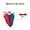Spasm of the arteries of the heart. Infographics. Vector illustration