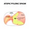 Spasms of the pylorus. Pylorospasm. atonic. Pyloric sphincter of the stomach. Infographics. Vector image on isolated background