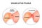 Spasms of the pylorus. Pylorospasm. Spastic and atonic. Pyloric sphincter of the stomach. Infographics. Vector