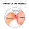 Spasms of the pylorus. Pylorospasm. Spastic and atonic. Pyloric sphincter of the stomach. Infographics. Vector image