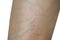 Spider veins on woman leg skin on white background. Concept before sclerotherapy or laser surgery to remove spider veins