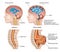 Spina Bifida Medical Illustration 