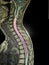 spinal cord tumor, illustration, MRI