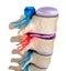 Spinal cord under pressure of bulging disc