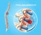 Spinal Disk Herniation Vector Medical Scheme