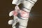 Spinal fracture, traumatic vertebral injury, illustration