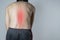 Spinal injury, Male back plan photo.