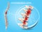 Spinal Osteoarthritis Realistic Vector Concept