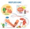 Spinal Reflex Arc scheme, vector illustration, with stimulus pathway through the nerve signals. Fun cartoon characters.