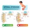 Spinal stenosis vector illustration. Labeled medical scheme. Diagram with nucleus, annulus, bone spurs and compressed spinal nerve