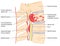 Spinal tumour