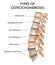 Spine Hernia Realistic Chart