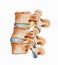 Spine - Lumbar Hyperlordosis