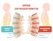 Spine osteoarthritis anatomical vector illustration diagram