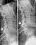 Spine and pelvis of a human body on x-ray. Two different split views