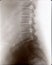 Spine and pelvis xray (x-ray)