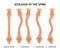 Spine Scoliosis Anatomy Infographics