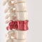 Spine with shattered vertebrae