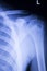 Spine vertebra ribs back injury xray scan