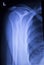 Spine vertebra ribs back injury xray scan