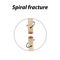 Spiral Bone Fracture. Infographics. Vector illustration on a lined background.