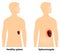 Splenomegaly or enlarged spleen