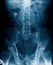 Spondylosis l-spine and pelvic bone
