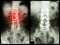 Spondylosis (Left image) , Patient was operated and internal fixed. (Right image)