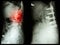 Spondylosis (Left image) , Patient was operated and internal fixed. (Right image) in old man